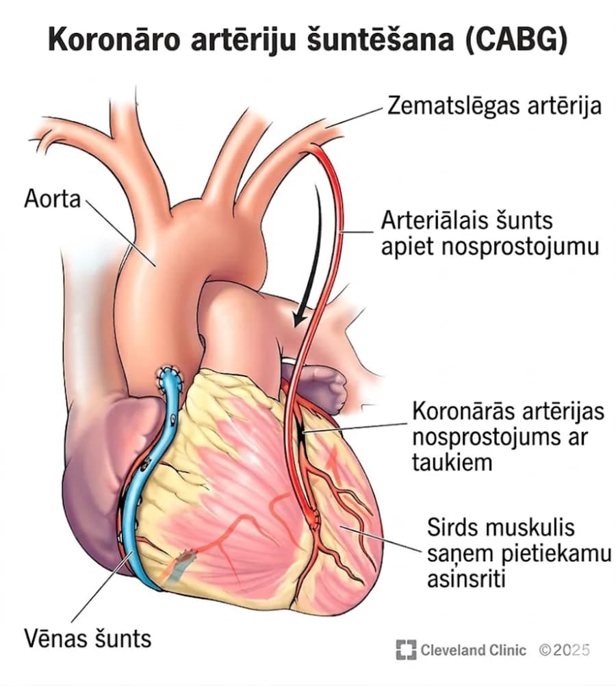 Attēls ar Sirds koronāriem a/v